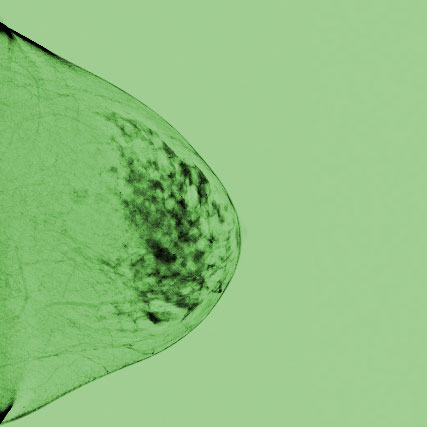 RFN ONLINE - Großer Kurs Mammadiagnostik, 09. & 10. und 14. & 15. März 2026